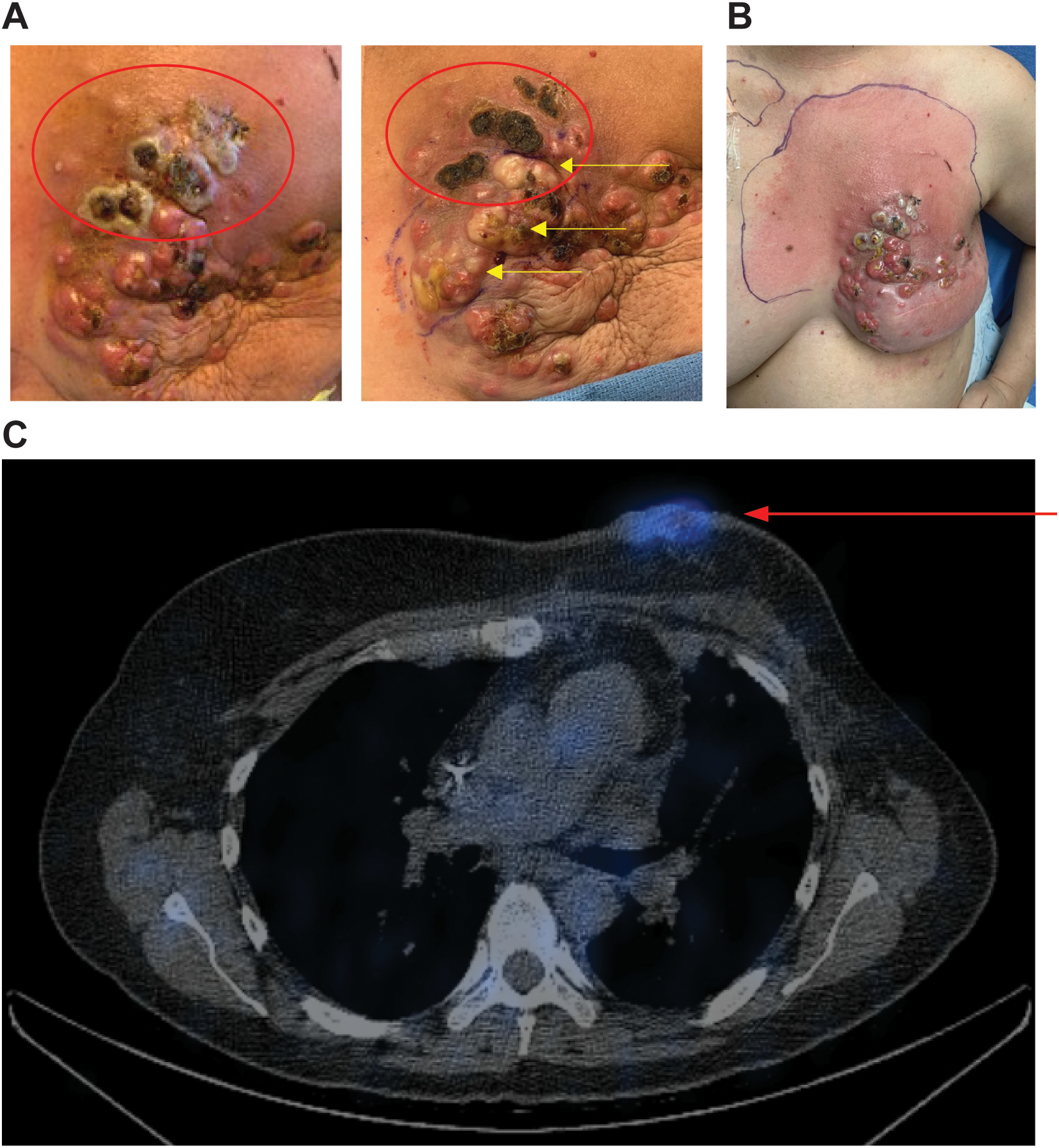 Three-panel image showing cancer progression and examination. Panel A displays skin lesions with areas of discoloration and ulceration on the breast. Panel B presents a broader view of the breast with inflamed and ulcerated areas. Panel C shows a cross-sectional CT scan highlighting a cancerous area with a blue marker, indicated by an arrow.