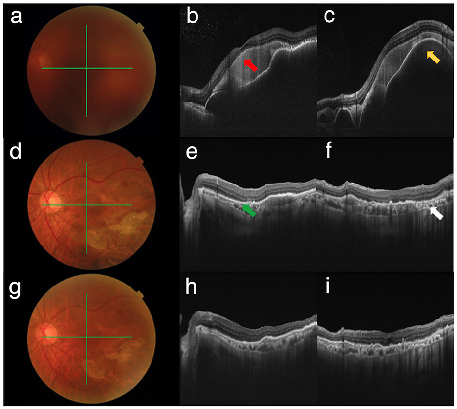 Fundus photographs and optical coherence tomography (OCT) images in a grid layout. Images a, d, and g are fundus photos showing the retina with markings. Images b and c are OCT scans with red and yellow arrows indicating retinal changes. Images e and f are OCT scans with green and white arrows marking different features. Images h and i show additional OCT scans highlighting retinal layers.
