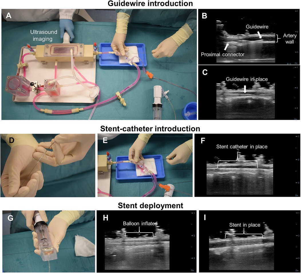 Guidewire and stent-catheter introduction, and stent deployment are depicted in labeled steps. Panel A shows the setup with ultrasound imaging. Panels B and C display ultrasound images of the guidewire in an artery. Panel D illustrates handling the stent-catheter. Panel E shows the introduction process, with Panel F depicting the catheter in place via ultrasound. Panel G illustrates stent deployment using a syringe-like tool. Panels H and I display ultrasound images of the stent deployment and placement.