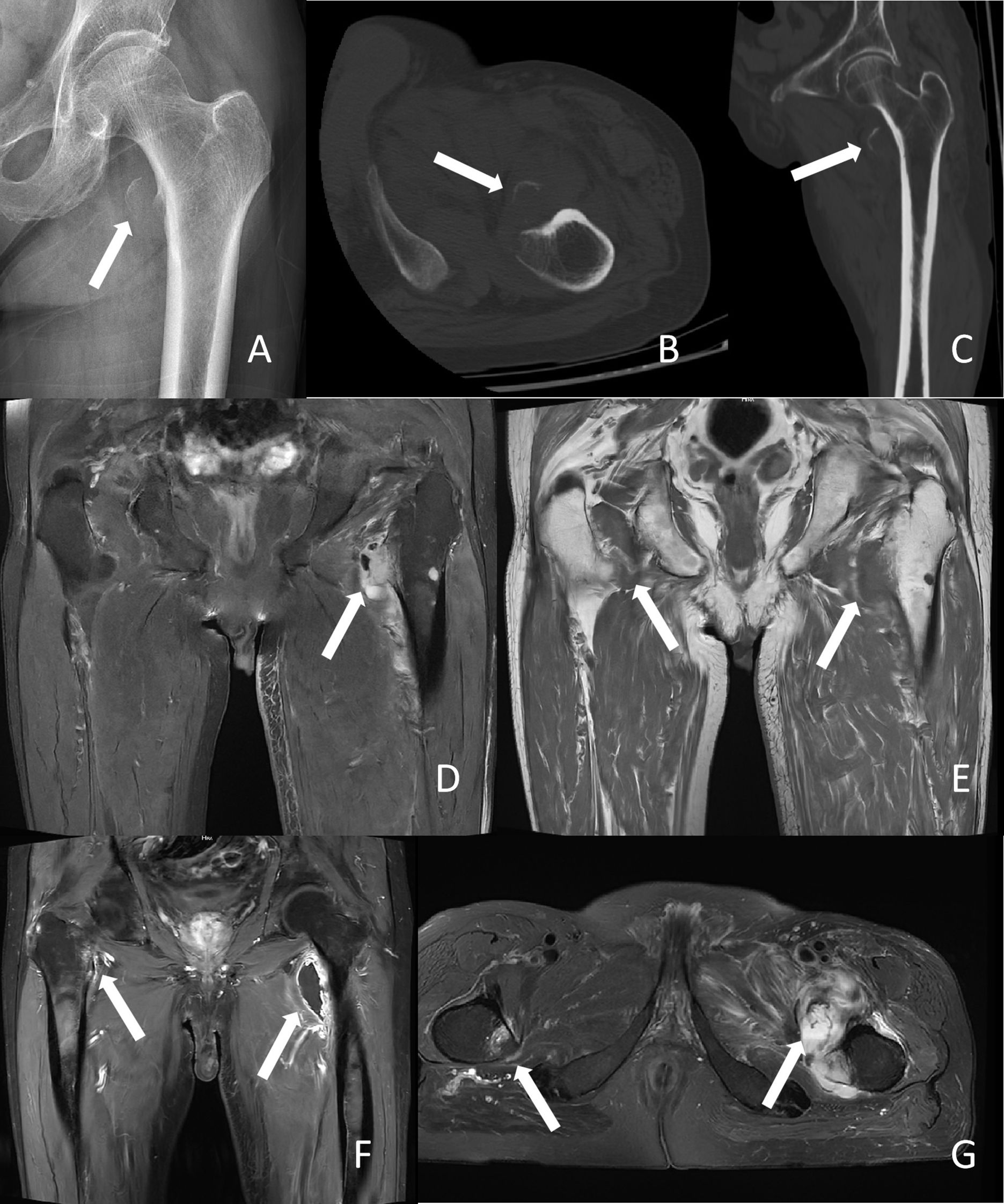 X-ray and MRI scans of hip region with arrows indicating areas of interest. Panel A shows a hip X-ray. Panels B and C are CT scans highlighting areas in the hip bone. Panels D to G are MRI scans of the pelvis, illustrating potential abnormalities or areas of concern in the hip joints and surrounding soft tissues.