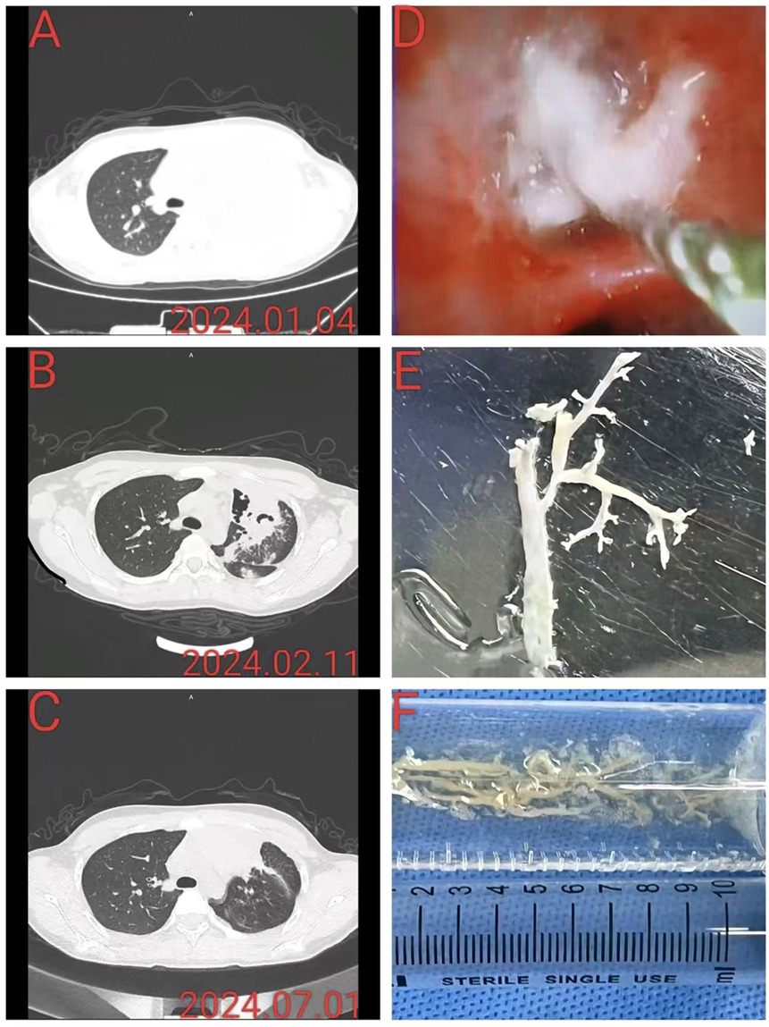 CT scans and photos depict a medical case: (1) Lung CT scan dated January 4, 2024, shows a clear lung. (2) Lung CT scan dated February 11, 2024, indicates lung obstruction. (3) Lung CT scan dated July 1, 2024, shows decreased obstruction. (4) Surgical image shows removal of material from the lung. (5) Extracted foreign object resembling a branch structure. (6) Measuring ruler with more removed material displayed.
