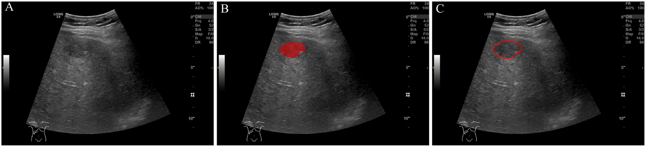 Three ultrasound images labeled A, B, and C display different views of internal structures. Image B shows a prominent red highlighted area, while image C has a smaller red circular outline around a region of interest. Image A is a grayscale ultrasound without highlights.