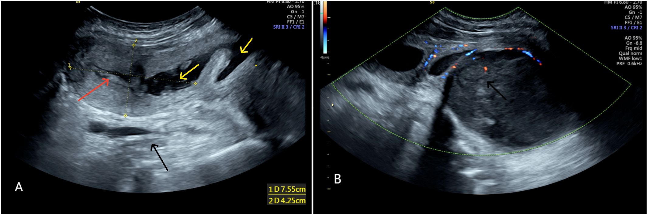 Ultrasound images labeled A and B. Image A shows a cross-sectional view with colored Doppler signals and a black arrow indicating a specific area. Image B shows another cross-sectional view with yellow arrows highlighting certain structures, a red arrow showing another point of interest, and a black arrow pointing to a distinct region. Measurement markers are visible in both images.