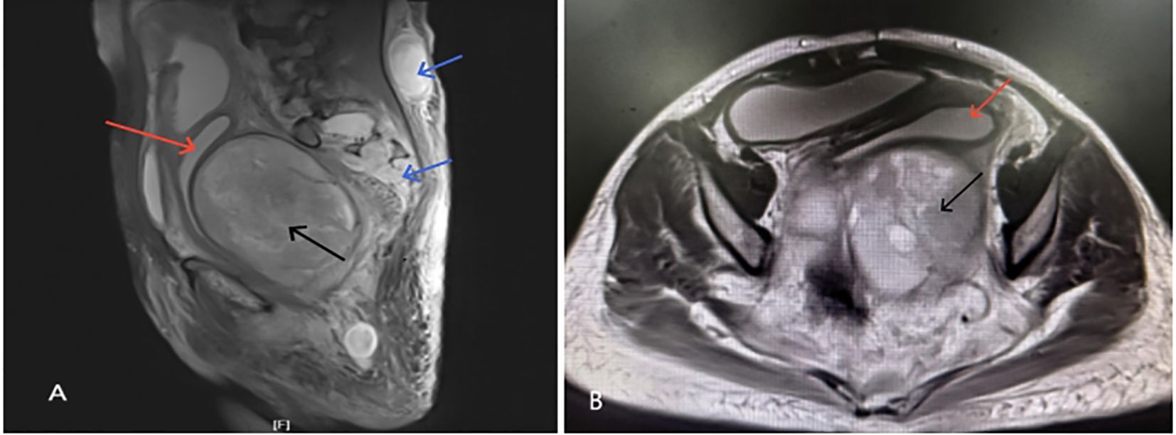 Panel A shows a sagittal MRI of a pelvic region with red, black, and blue arrows indicating specific anatomical structures. Panel B presents an axial MRI of the same area, with red and black arrows highlighting key areas. Both images focus on examining internal features, possibly denoting abnormalities or areas of interest.