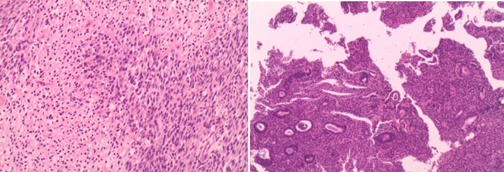 Composite image showing two histological slides. The left image shows densely packed cells with elongated nuclei, likely suggesting fibrous tissue or a tumor. The right image depicts glands and irregular structures surrounded by stroma, possibly indicating an epithelial tissue pattern. Both slides are stained with hematoxylin and eosin, highlighting cell structures in shades of pink and purple.