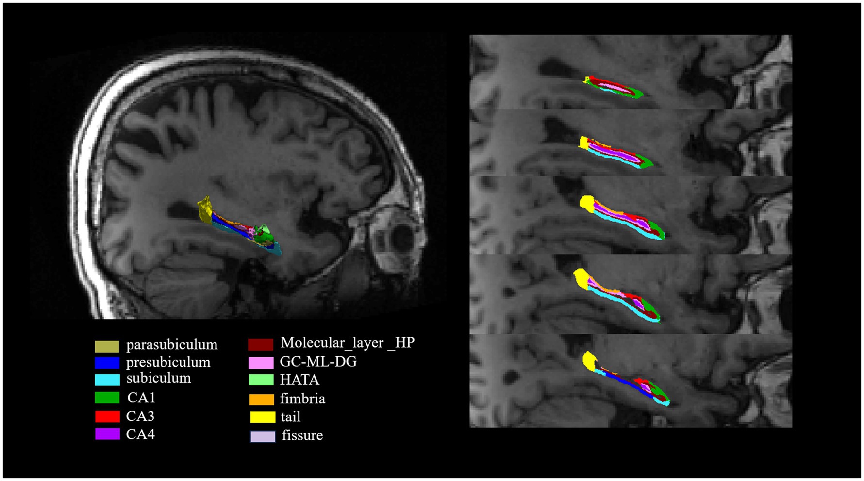 MRI brain scan showing hippocampal subregions in different colors, including parasubiculum, presubiculum, subiculum, CA1, CA3, CA4, GC-DG, HATA, fimbria, Molecular layer HP, and tail. The left side displays a sagittal view with highlighted regions, and the right side shows layered sections with color-coded labels corresponding to a legend.