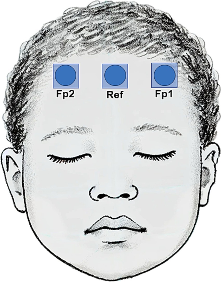 Illustration of a child’s face with three labeled blue circles on the forehead: “Fp2” on the left, “Ref” in the center, and “Fp1” on the right, possibly indicating electrode positions.