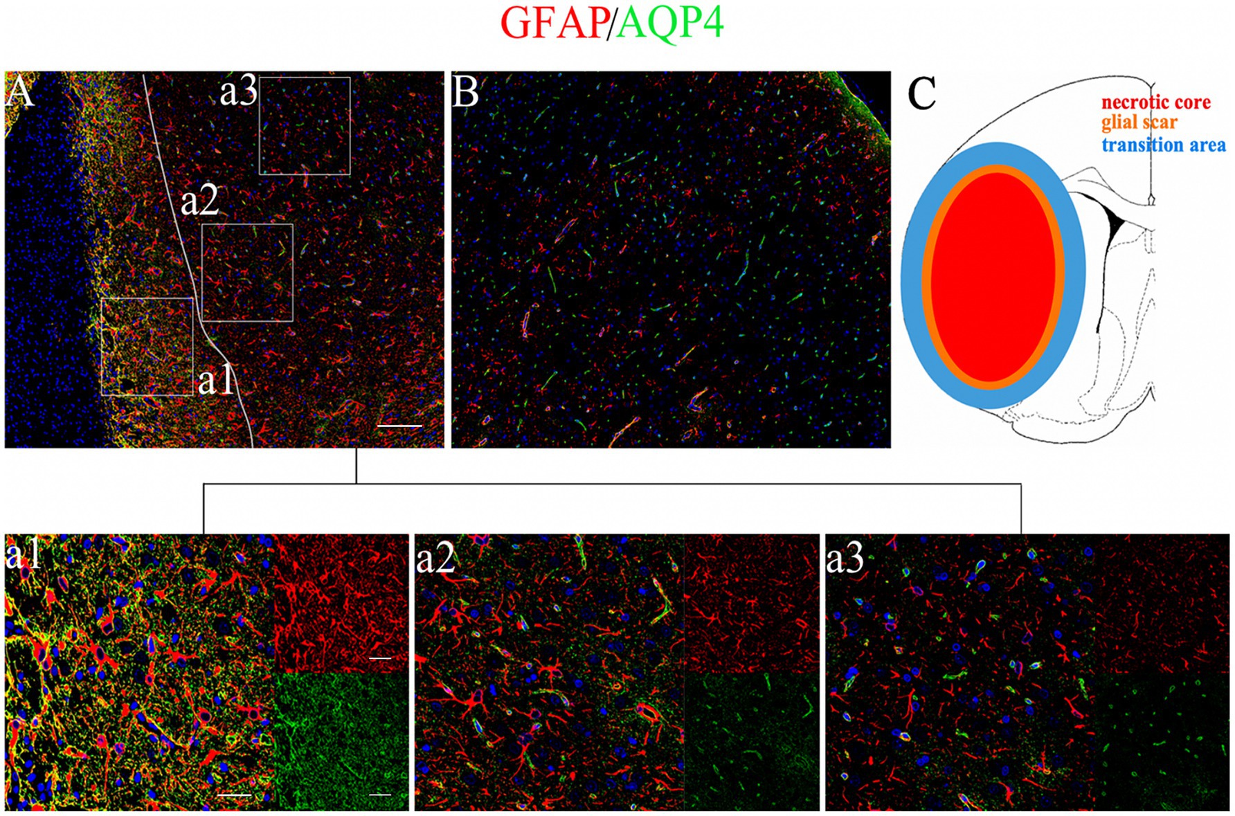 Fluorescent microscopy panels showing astrocytic markers GFAP in red and AQP4 in green across different brain regions labeled A1, A2, and A3. Panel C illustrates a necrotic core in red, a glial scar in orange, and a transition area in blue. Each panel highlights different cellular distributions.