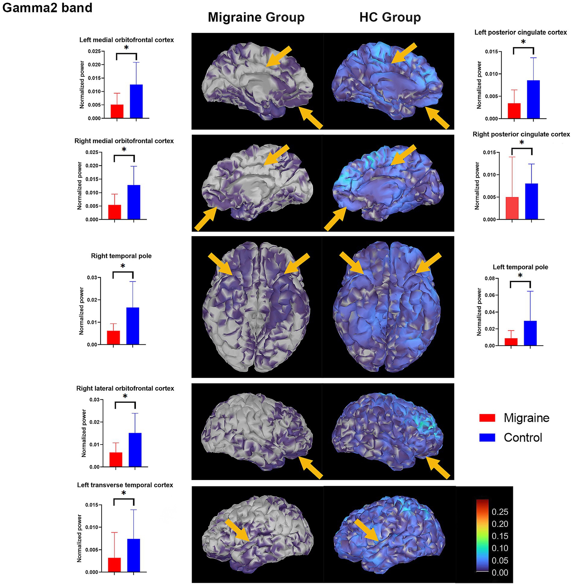 Brain activity comparisons in the gamma2 band between migraine and control groups. The image features brain scans with arrow indicators highlighting specific regions such as the orbitofrontal cortex, temporal pole, and cingulate cortex. Bar graphs on the sides show normalized power for each region, with red bars for migraine and blue for controls. Significant differences are marked with asterisks. A color scale ranges from red to blue, indicating varying levels of brain activity.