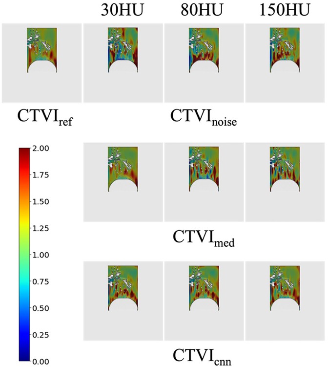 Series of color-coded graphical images showing different computed tomography visual indexes (CTVI) at varying Hounsfield Units (HU) of 30, 80, and 150. The images are organized in three rows labeled CTVI_ref, CTVI_noise, CTVI_med, and CTVI_cnn, with a color scale ranging from blue to red, representing values from 0.00 to 2.00. Each row contains three images corresponding to the HU levels. The visualization shows variations in image noise and detail at different HU values across different CTVI methods.