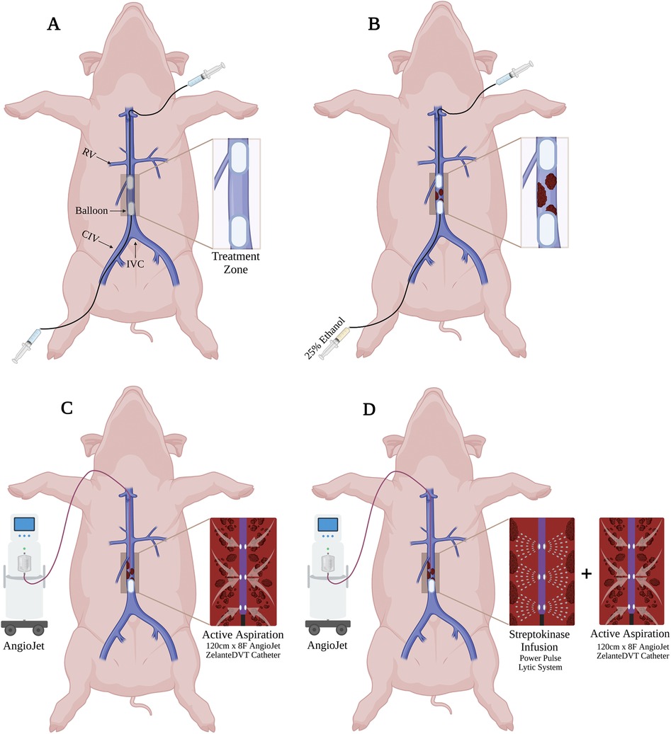 Illustration of a medical procedure using a pig model. Panel A shows a catheter with a balloon in the inferior vena cava. Panel B introduces 25 percent ethanol into the treatment zone, with red areas indicating effects. Panel C displays active aspiration with AngioJet and visible changes in the veins. Panel D combines streptokinase infusion with active aspiration, showing the process and effects in the vascular system. Each panel demonstrates different stages and methods of the procedure, with detailed insets highlighting changes.