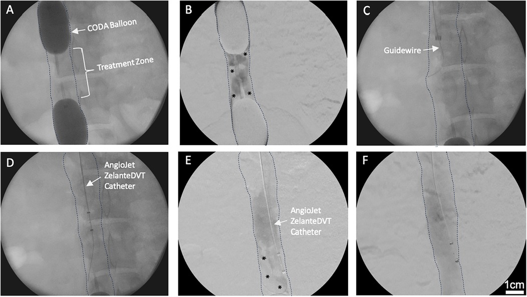 Series of six x-ray images showing a medical procedure. Image A features a CODA Balloon with a labeled treatment zone. Image B highlights the treatment zone with asterisks. Image C displays a guidewire. Image D shows an AngioJet ZelanteDVT Catheter in place. Image E focuses on the catheter with asterisks marking key areas. Image F presents the catheter in situ. Each image is annotated with dotted lines outlining the area of interest.