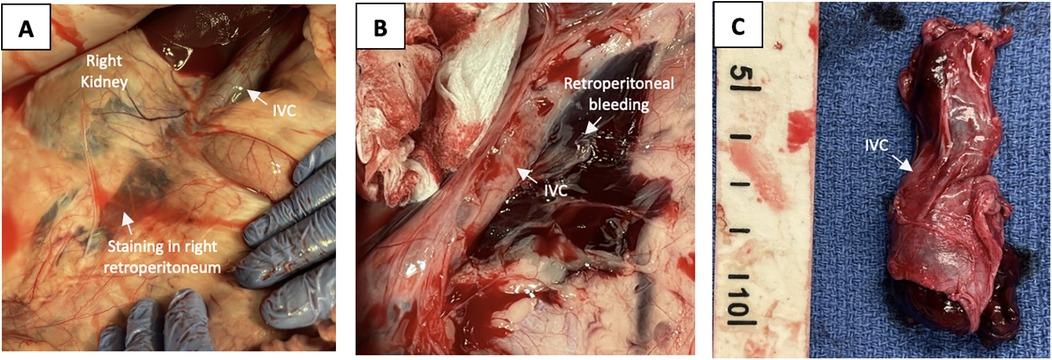 Panel A shows the right kidney with staining in the right retroperitoneum, and the inferior vena cava (IVC) is visible. Panel B depicts retroperitoneal bleeding surrounding the IVC. Panel C displays an excised section of the IVC placed on a blue surgical drape next to a measuring scale.