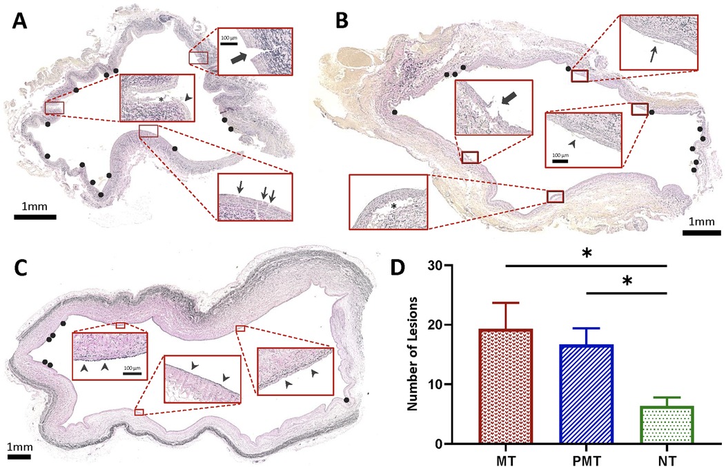 Histological images labeled A, B, and C show cross-sections of a tubular structure with detailed insets highlighting different areas, marked by arrows and asterisks. Image D is a bar graph comparing the number of lesions among three groups: MT, PMT, and NT. MT has the highest count, followed by PMT, then NT. Asterisks indicate significant differences. Scales of 1 millimeter and 100 micrometers are noted in the images.