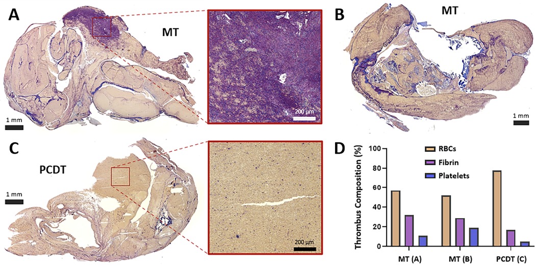 Histological sections (A and B) show thrombus composition after mechanical thrombectomy (MT), with detailed inset images highlighting fibrin. Section C displays a thrombus after pharmacomechanical catheter-directed thrombolysis (PCDT), showing less fibrin. Graph D compares the thrombus composition percentages of red blood cells (RBCs), fibrin, and platelets for MT and PCDT, with MT showing higher fibrin content.