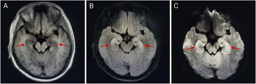 MRI brain scans in axial view labeled A, B, and C. Each image shows red arrows pointing to distinct areas within the brain's structure, highlighting specific regions for comparison or analysis.