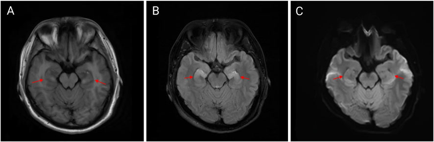 Three brain MRI images labeled A, B, and C. Each image highlights specific regions with red arrows. Image A and C show bilateral symmetrical regions, while image B demonstrates a bright area on the right side of the brain.