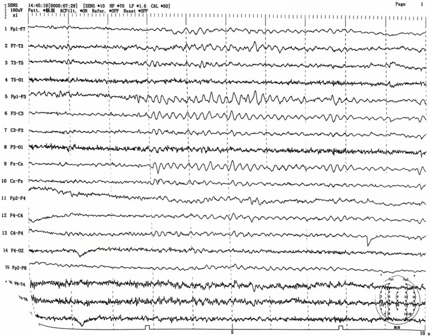 EEG graph displaying multiple channels of brain wave activity. Each line represents electrical activity between different electrode pairs, labeled on the left. The waves exhibit varying amplitudes and frequencies, indicating different brain activity patterns over time.