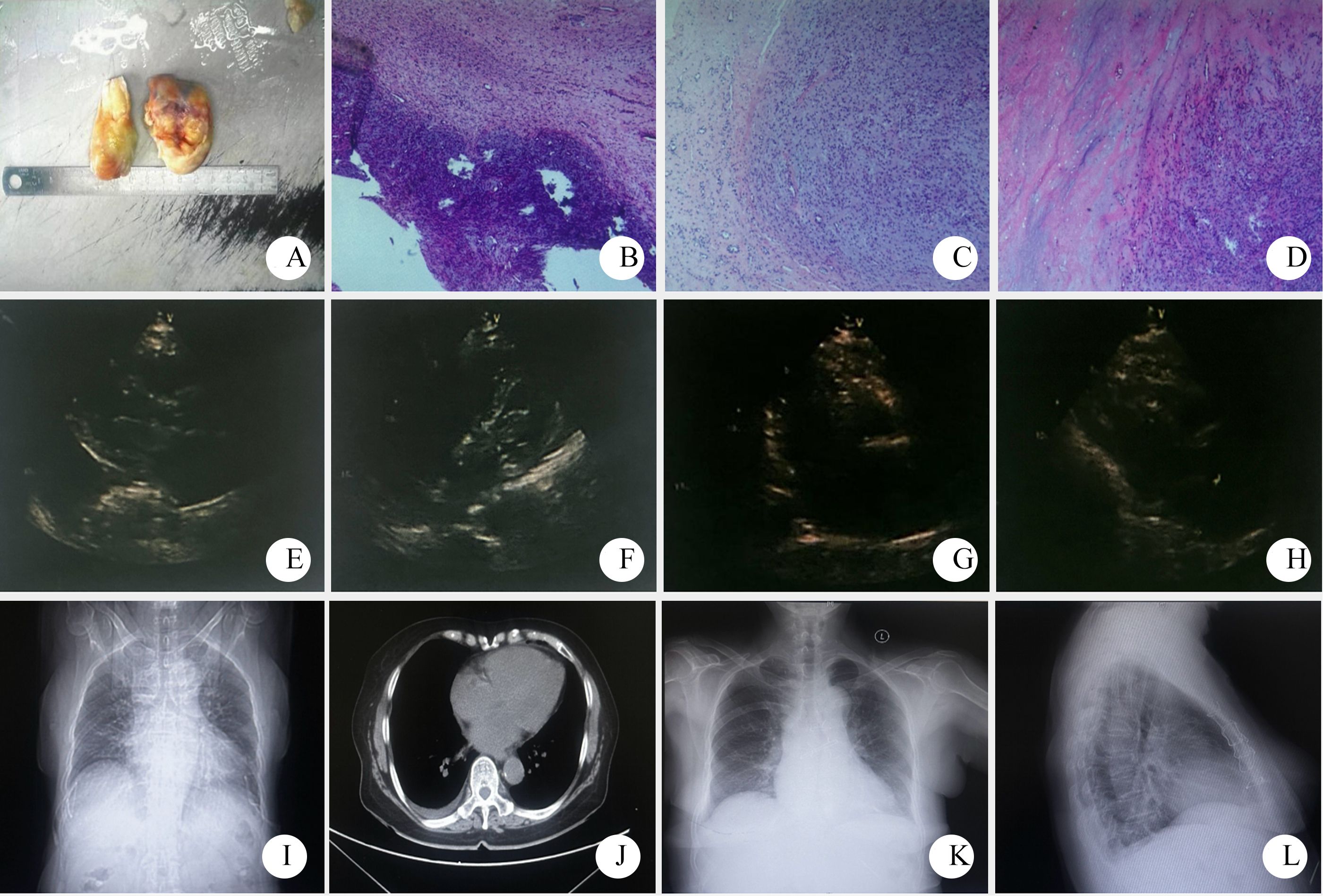Panel A shows a specimen of excised cardiac tissue with a ruler for scale. Panels B, C, and D depict histological slides with varying cellular patterns and staining. Panels E, F, G, and H display echocardiographic images showcasing the heart's structure. Panel I is a chest X-ray showing skeletal and soft tissue structures. Panel J presents a CT scan cross-section of the thorax with the heart clearly visible. Panels K and L display chest X-rays from different views, indicative of respiratory and cardiac evaluation.
