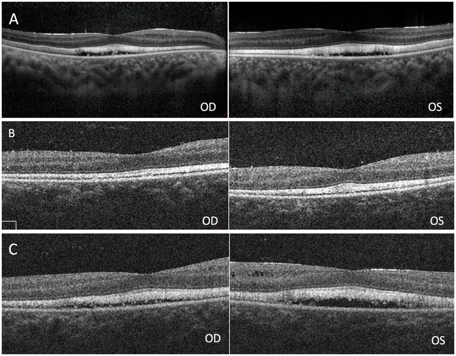 Optical coherence tomography scans of the retina from both eyes, labeled A, B, and C. Images labeled OD (right eye) and OS (left eye) show cross-sectional retinal layers. A displays thicker layers, while B and C show progressively thinner layers, indicating varied retinal conditions.