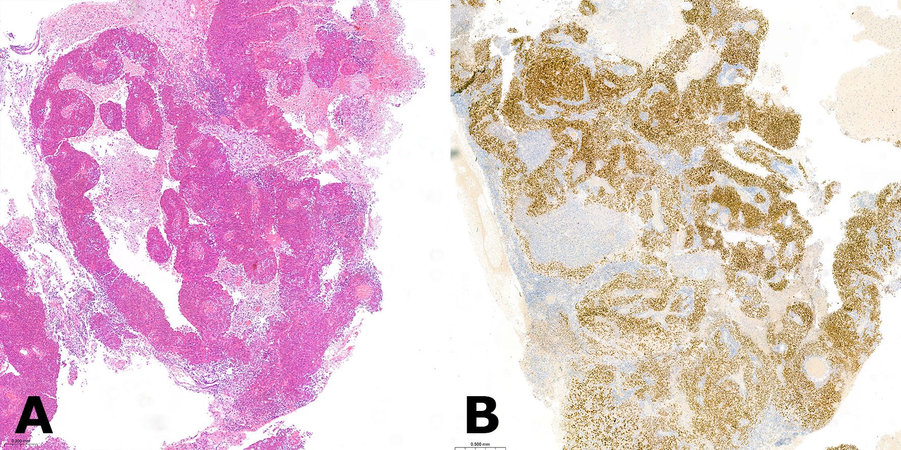 Histological comparison of two images labeled A and B. Image A shows a tissue sample stained pink with hematoxylin and eosin, displaying detailed cellular structures. Image B shows the same sample stained brown and blue, highlighting specific protein expression. Both images illustrate different staining techniques for analyzing tissue morphology and protein presence.
