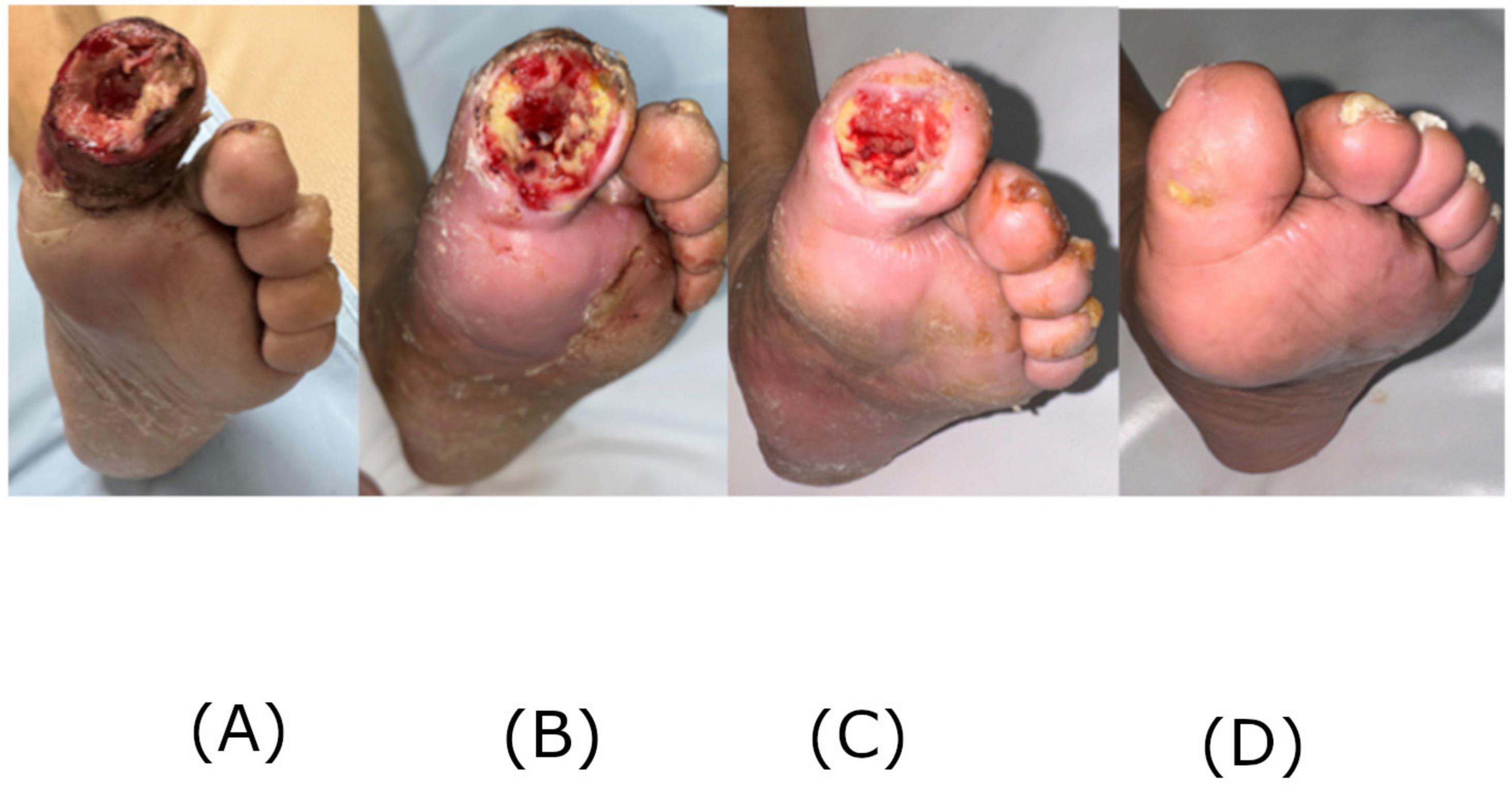 Four images of a foot showing different stages of wound healing on the toes. (A) Severe wound with exposed tissue and discoloration. (B) Healing wound with reduced redness. (C) Further reduced wound size and redness. (D) Healed foot with intact skin.