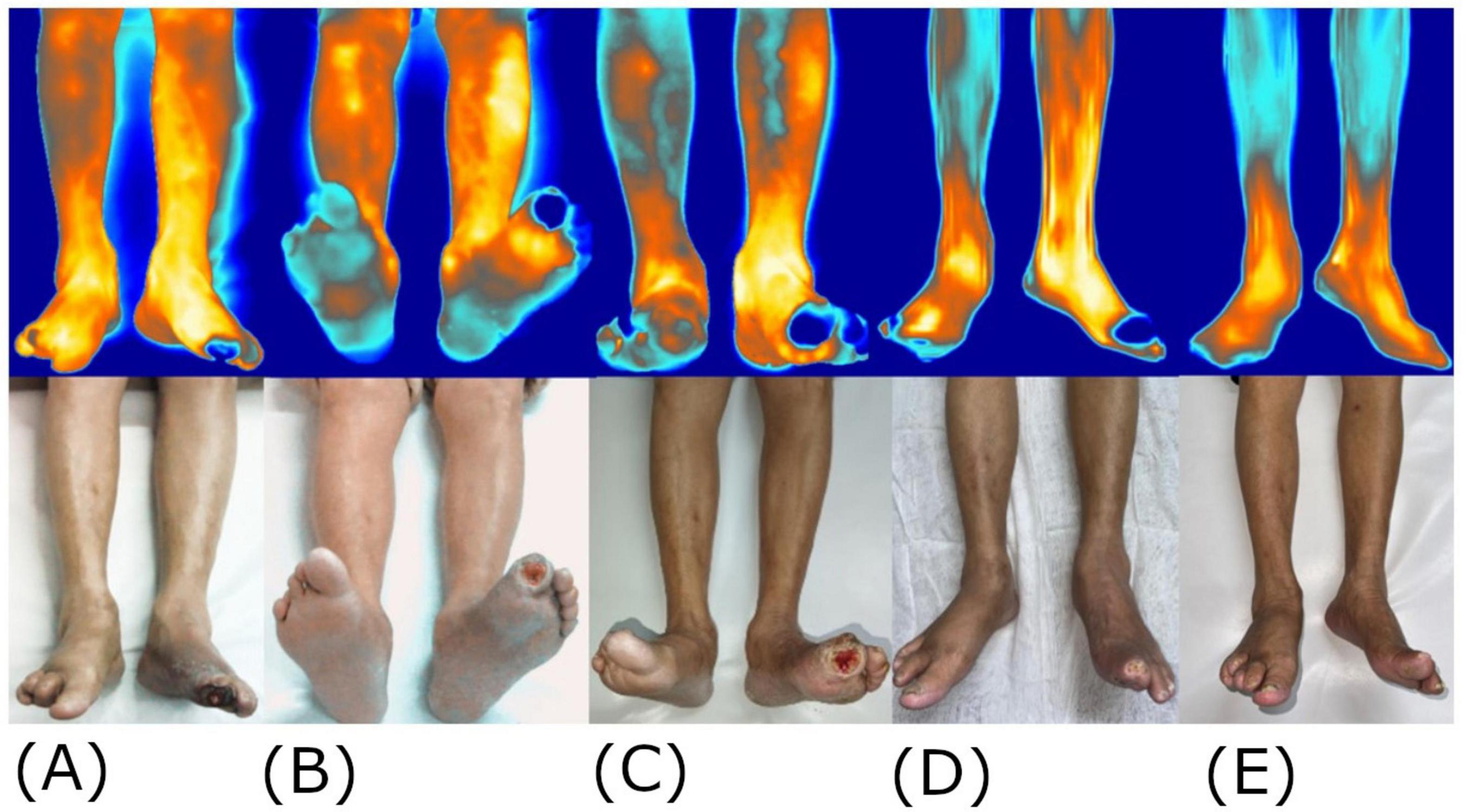 Thermal images of feet show temperature variations in contrasting colors, with corresponding photographs of feet displaying signs of injury or deformity. Each set from A to E features a thermal image above and a matching photograph below, depicting various conditions like swelling or lesions on the feet.