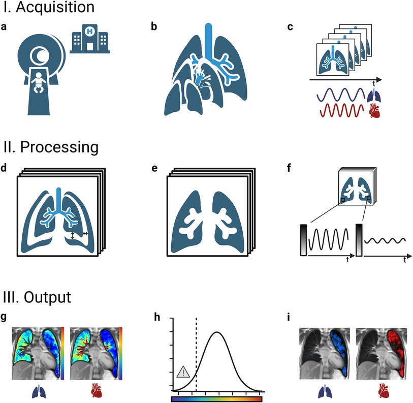 Diagram illustrating a process broken into three sections: Acquisition, Processing, and Output. \n\n1. Acquisition: \n - (a) Illustration of a baby in a hospital scanner.\n - (b) Image of lungs with inner details highlighted.\n - (c) Series of imaging slices with time-related waveforms.\n\n2. Processing:\n - (d) Stacked lung images with marked internal directions.\n - (e) Multiple aligned lung images.\n - (f) Diagram showing signal processing over time.\n\n3. Output:\n - (g) Colored lung and heart images.\n - (h) Graph with a warning and color scale.\n - (i) Lung and heart images displayed with colored overlays.