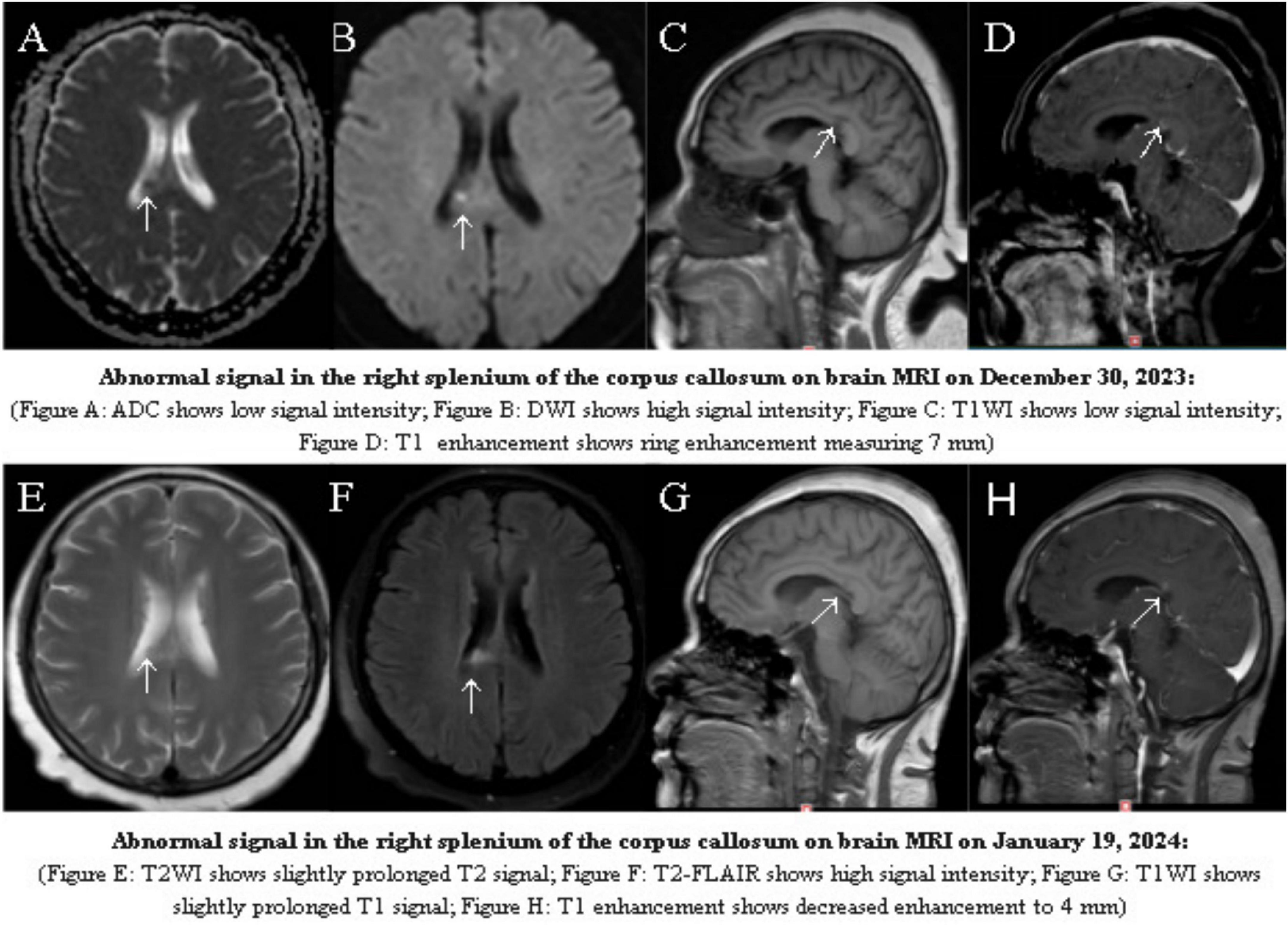 Brain MRI images show abnormal signals in the right splenium of the corpus callosum. The top row from December 30, 2023, includes ADC and DWI with varying signal intensities, T1-weighted imaging (T1WI) with low signal, and a T1 enhancement showing a 7 millimeter ring enhancement. The bottom row from January 19, 2024, shows T2-weighted imaging (T2WI) with slightly prolonged T2 signal, T2-FLAIR with high intensity, and T1WI with slightly prolonged T1 signal and decreased enhancement to 4 millimeters. Arrows indicate areas of interest.