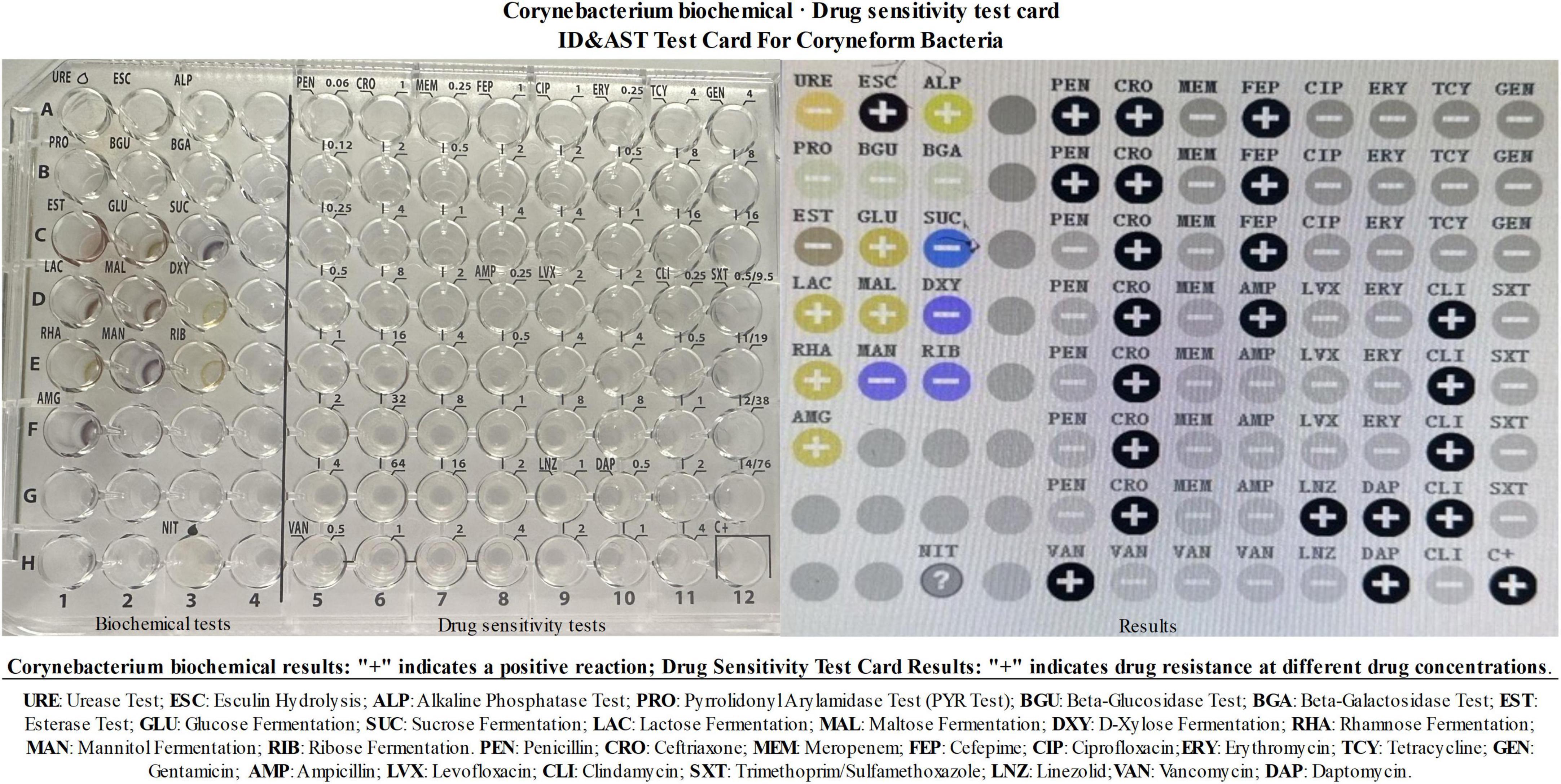 Corynebacterium biochemical and drug sensitivity test card displaying results for various tests. Left panel shows biochemical tests with wells for each reagent and indicators of positive reactions. Right panel presents drug sensitivity with varying drug concentrations and effectiveness indicated by symbols. Results explanation includes test types like urease, glucose fermentation, and antibiotic reactions with details on specific reagents such as penicillin and vancomycin. “+” denotes positive reaction or resistance.