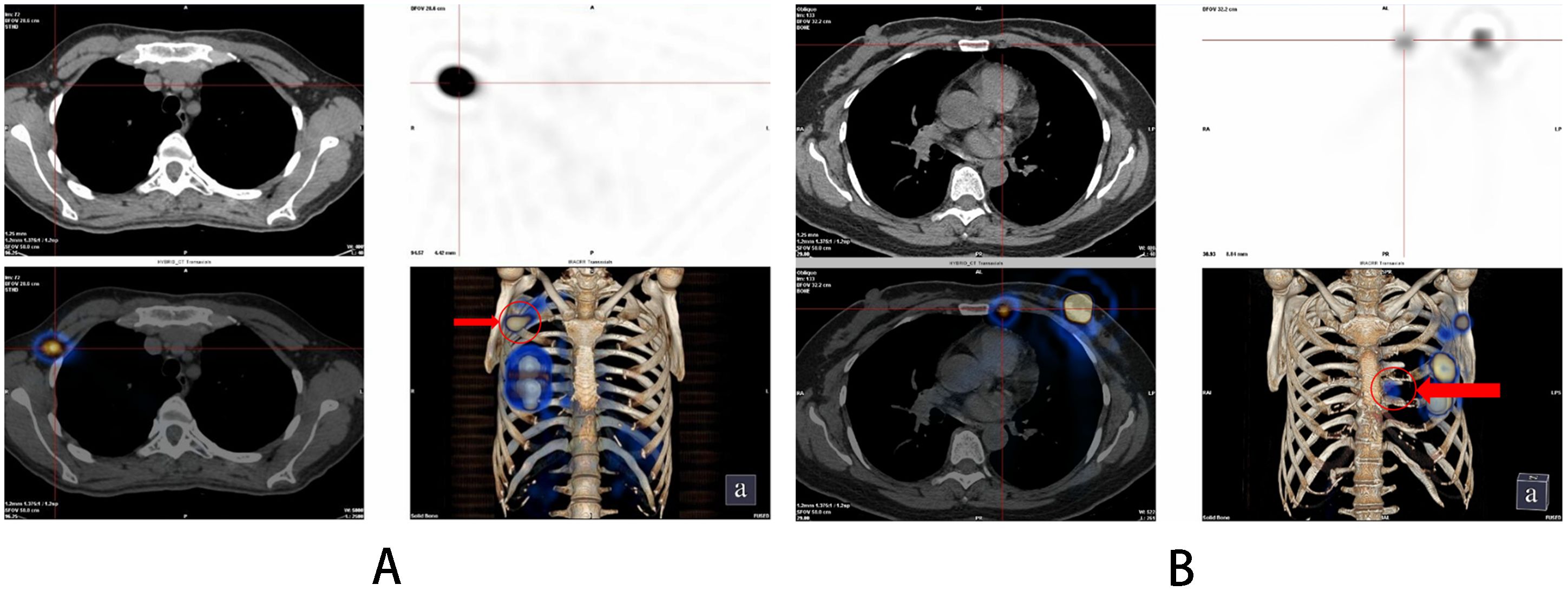 CT and PET scan comparisons in panels A and B. Both panels display cross-sectional images of the thorax, showing areas of increased radiotracer uptake highlighted in color. The 3D skeletal views include red arrows and circles pinpointing specific areas of interest on the ribcage. Panel A and B emphasize different sites of concern within the chest.