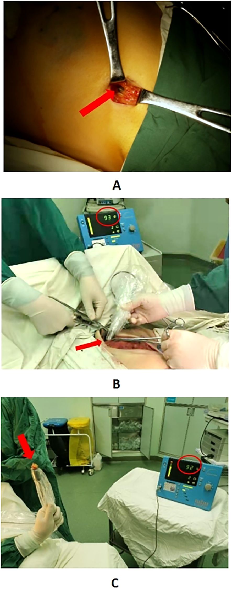 Panel A shows a surgical incision on a patient's side, highlighted by a red arrow, with retractors used to open the wound. Panel B displays a surgical procedure in progress with medical instruments and a blue device showing a reading of ninety-three. Panel C reveals a medical professional holding a wrapped item with a red arrow, and a blue machine displaying a reading of ninety-two in the background.