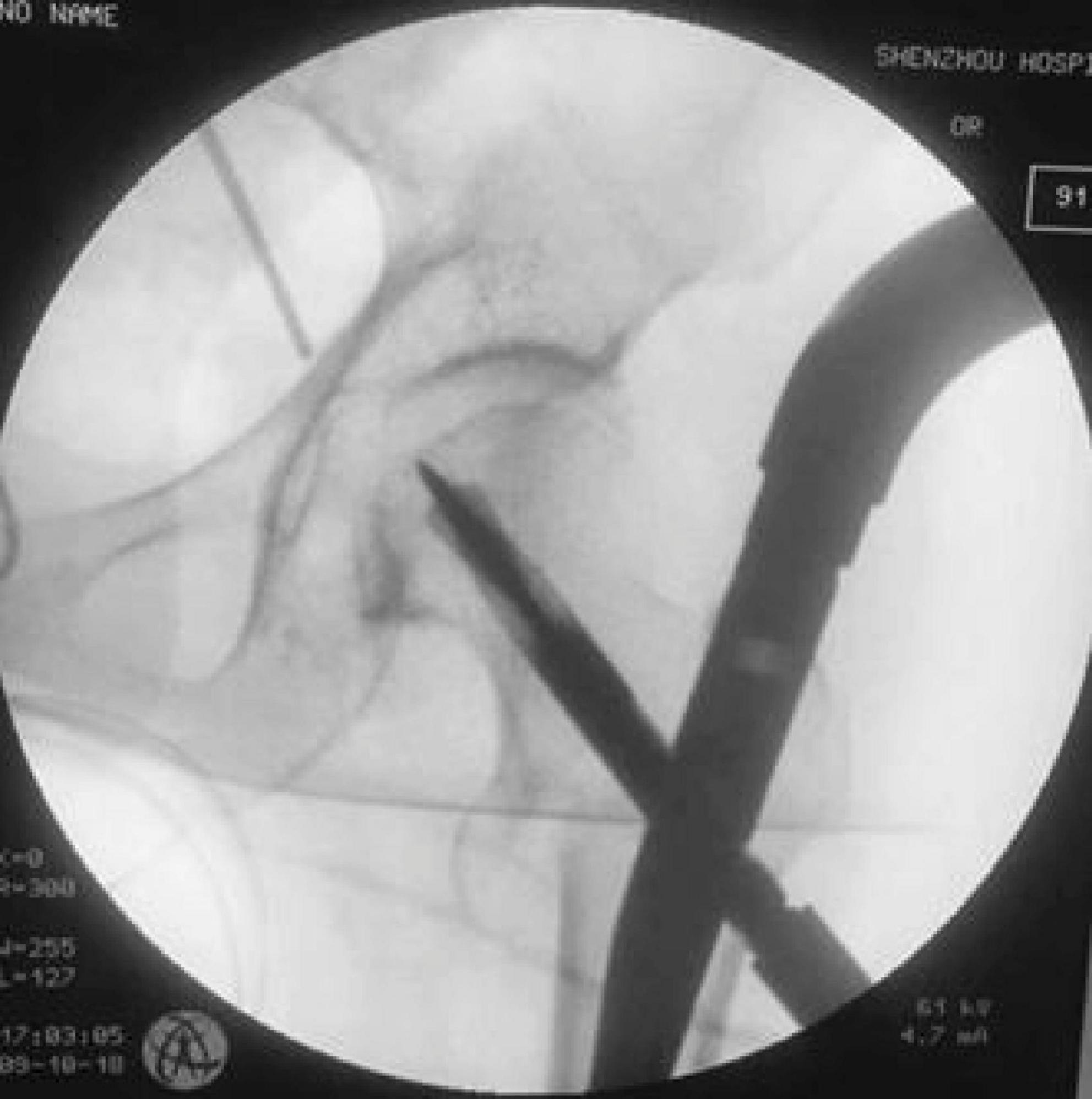 X-ray image showing a surgical procedure involving the hip joint. Instruments are visible inside the body, positioned near the joint area, with the pelvic bone structured around them.