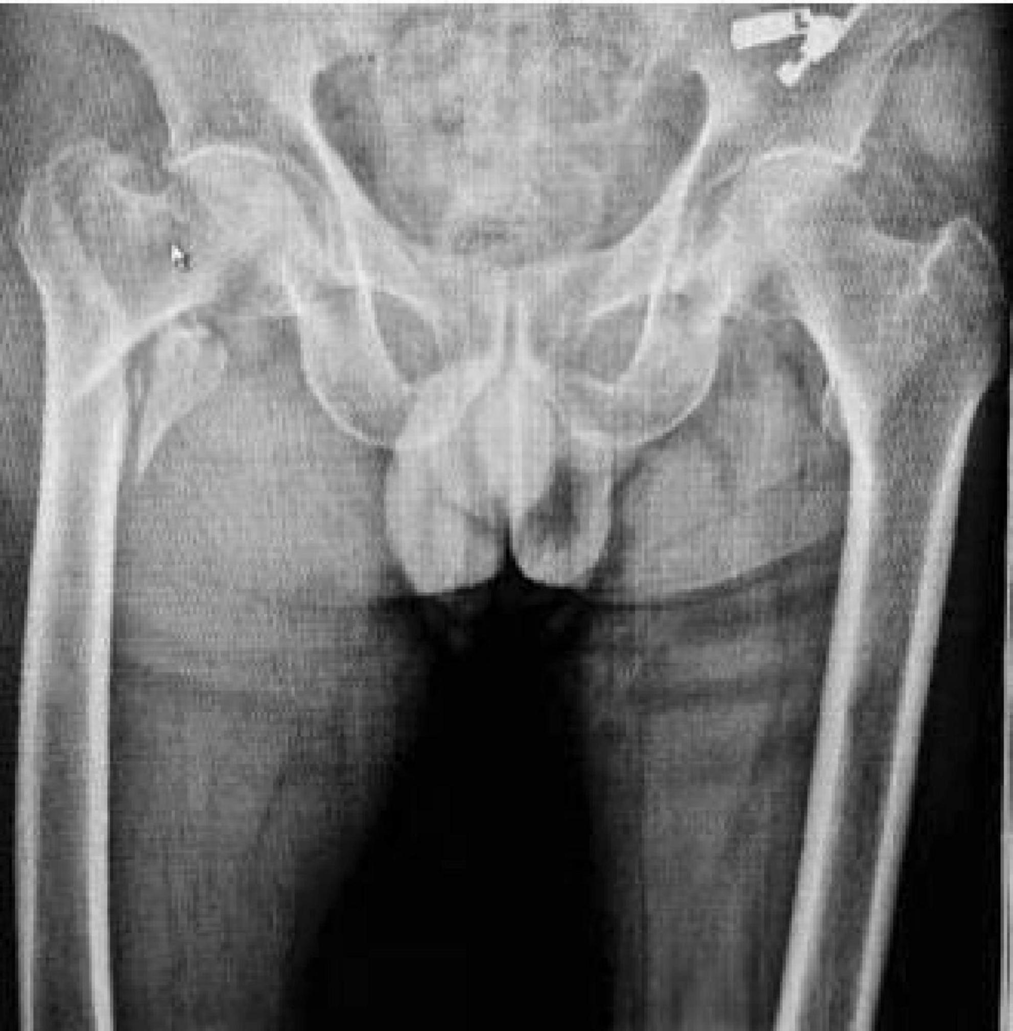 X-ray image showing a pelvic region with a noticeable object beneath the surface of the pelvis. The X-ray also includes the upper femur bones and some soft tissue details.