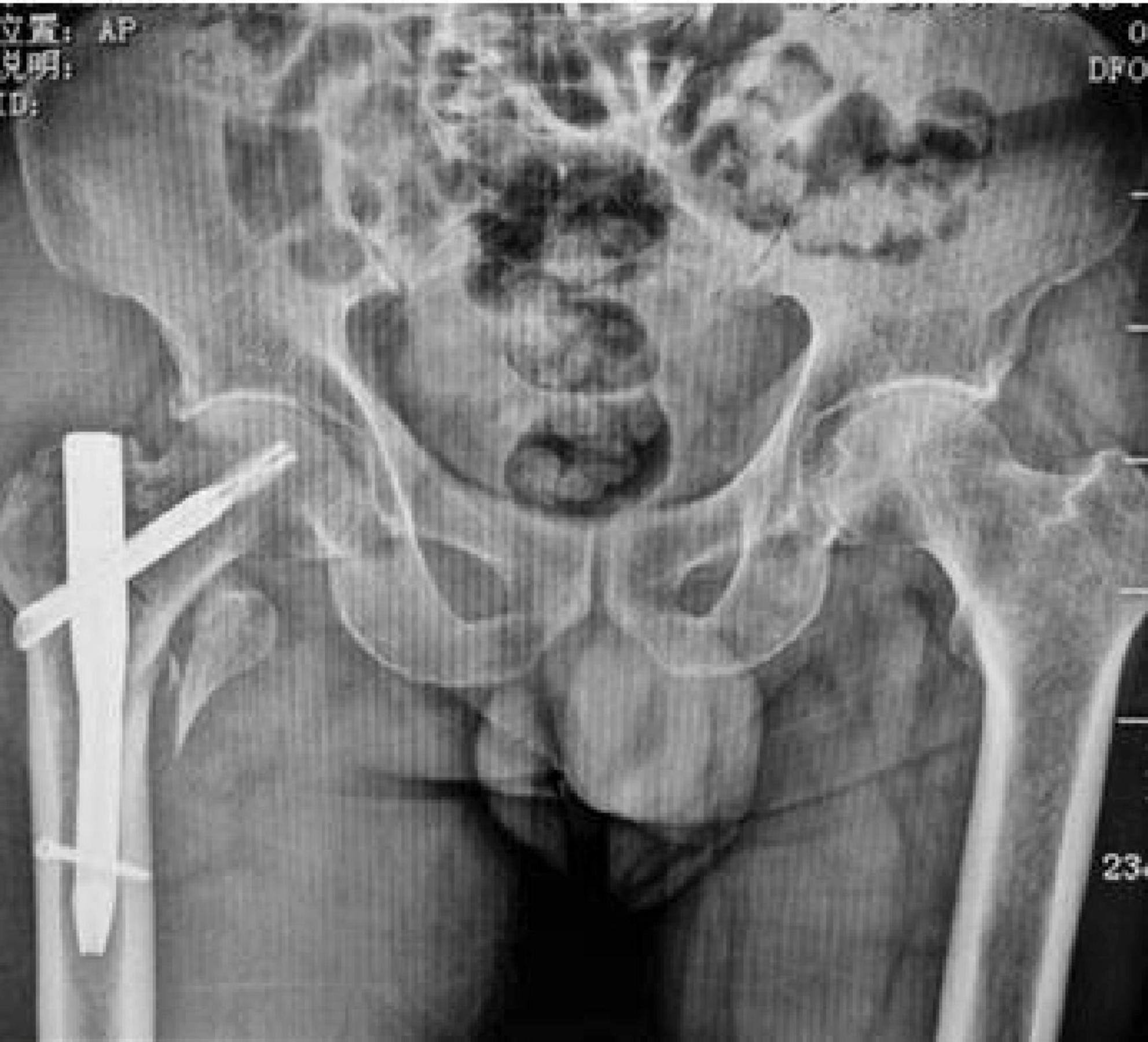 X-ray image showing surgical screws inserted into a bone, likely for repair or stabilization. The screws appear aligned within the skeletal structure, surrounded by soft tissue. Medical facility details are visible around the image border.