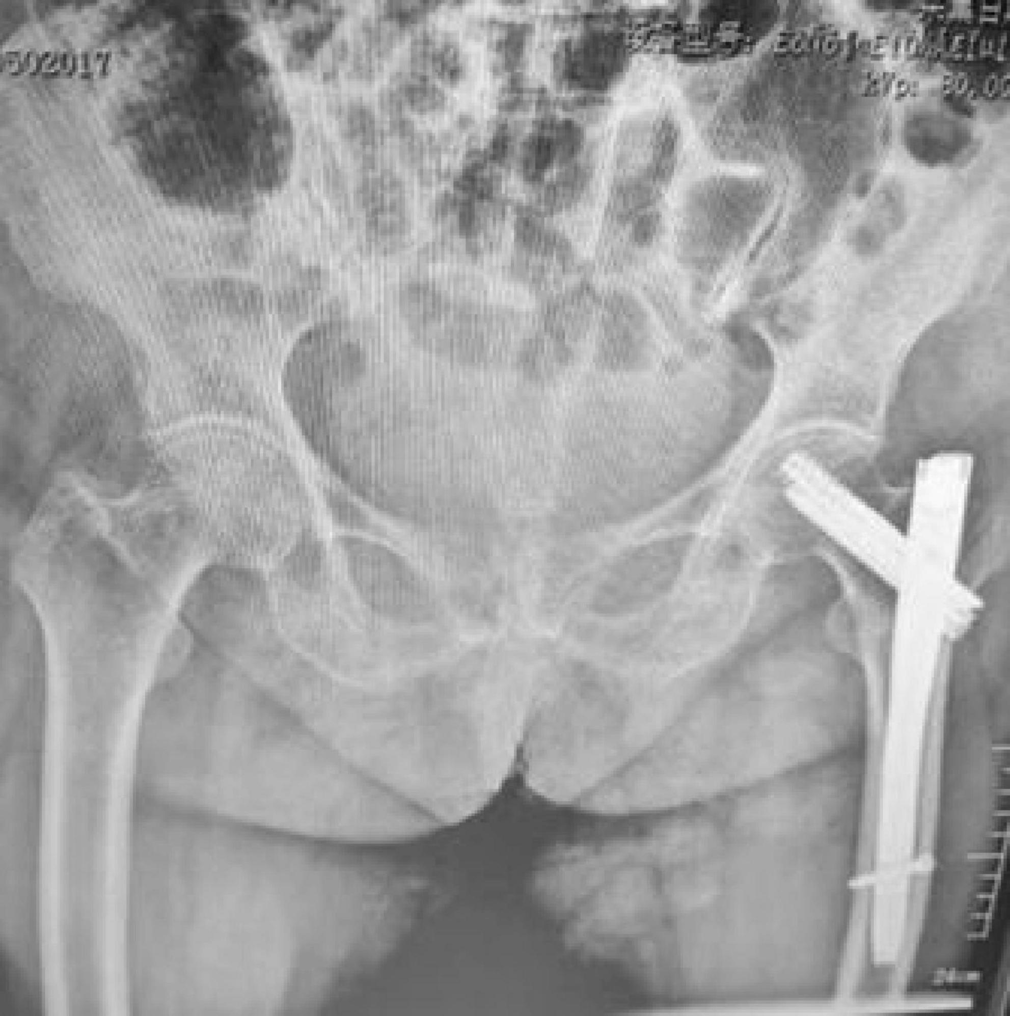 An X-ray image of a pelvis showing a metal implant in the right leg. The implant appears to be a surgical fixation device spanning from the hip to the upper femur, indicating post-operative stabilization.
