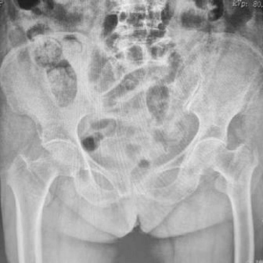 X-ray image showing the pelvis and lower spine, including the hip joints and femur bones. Details of the vertebrae and pelvic structure are visible, with varying shades indicating bone density and soft tissue.