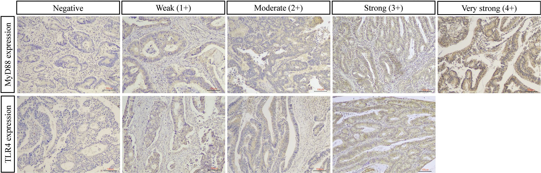Microscopic images display varying levels of MyD88 and TLR4 expression in tissues. The top row shows MyD88 expression from negative to very strong, while the bottom row illustrates TLR4 expression similarly. Each image demonstrates cellular staining, with intensity increasing from left to right, labeled as negative, weak, moderate, strong, and strong. The scale bar indicates 100 micrometers.