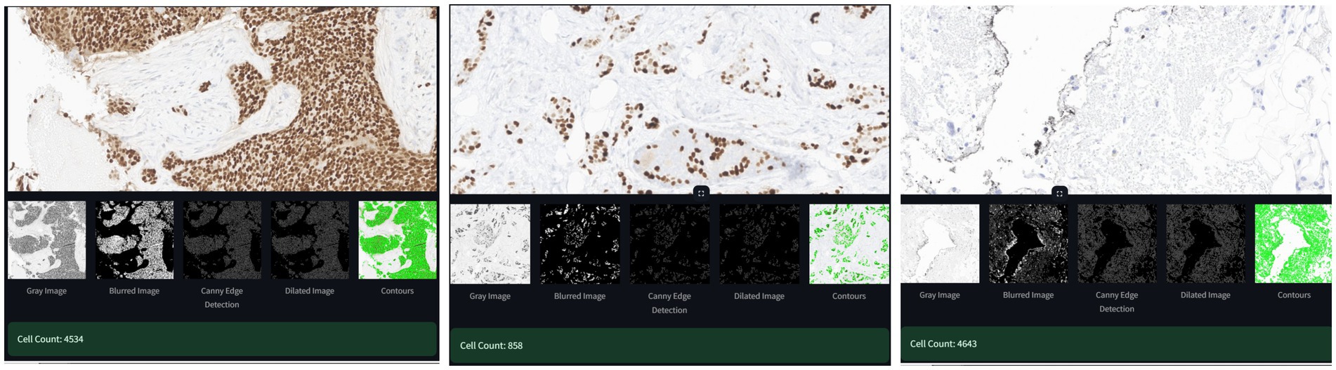 Three panels show histological images with corresponding processed images beneath each. The left panel shows dense brown-stained cells, with processed versions as gray, blurred, edge-detected, dilated, and contoured images. Cell count is 4534. The middle panel displays less dense cell staining, with similar processed images. Cell count is 858. The right panel has sparse staining with the same processing types. Cell count is 4643.