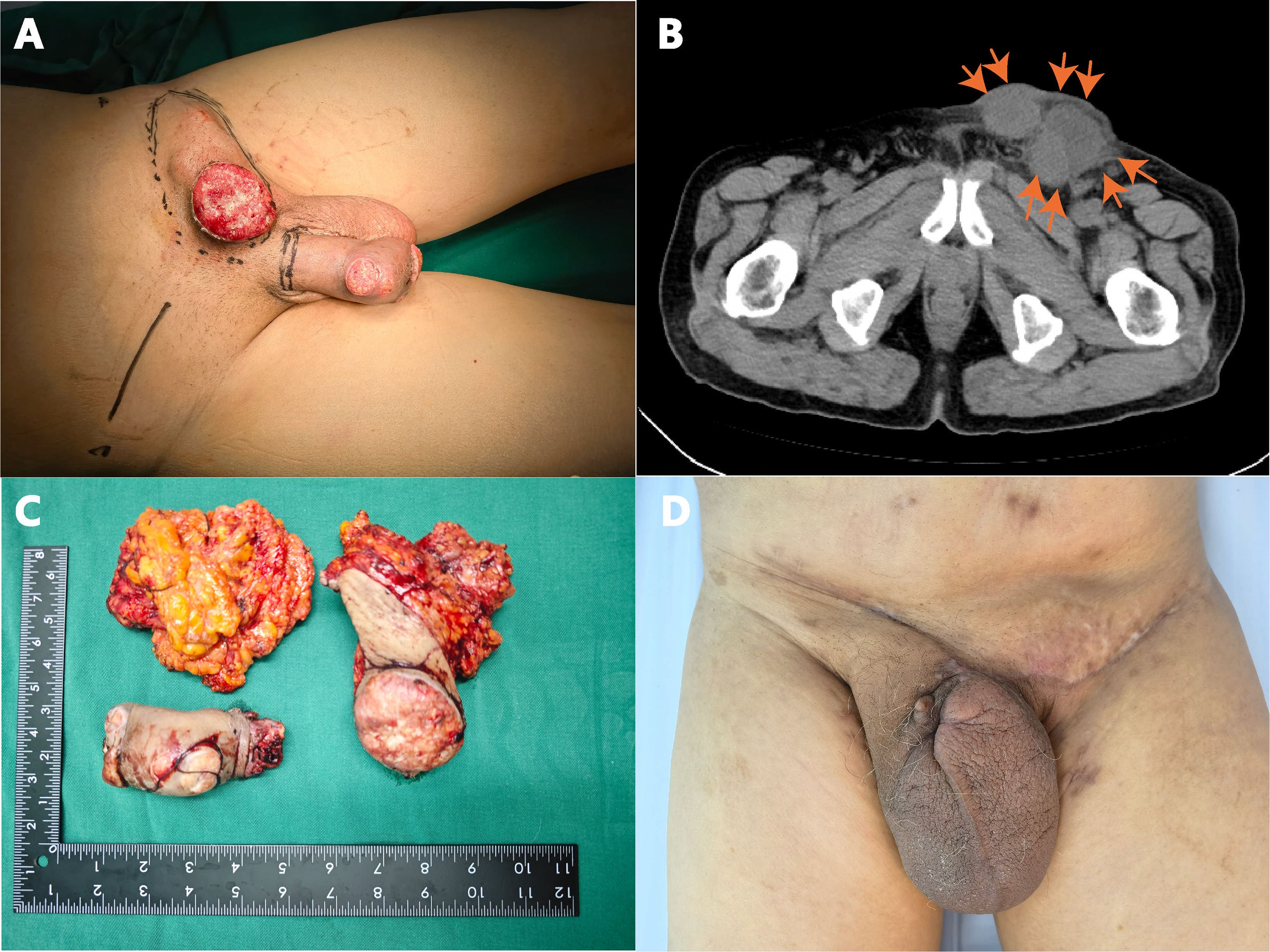 A series of medical images depicting different stages of a condition. A shows a lesion on the groin area. B is a CT scan highlighting abnormal growths with arrows. C displays excised tissue samples alongside a ruler for scale. D shows the healing of the groin area post-surgery.