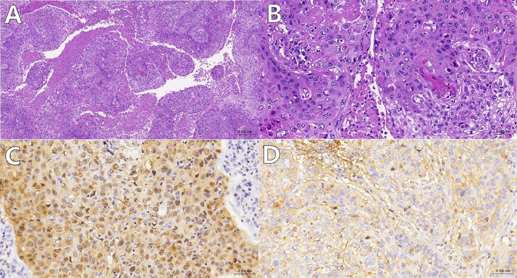 Histological and immunohistochemical images labeled A to D. Image A and B show tissue stained with hematoxylin and eosin, highlighting cellular structures with varying magnifications. Images C and D exhibit tissue stained for specific proteins, showing different intensities and patterns, with some areas marked by darker brown staining. Each image provides detailed views of the cellular morphology and protein expression within the tissue.