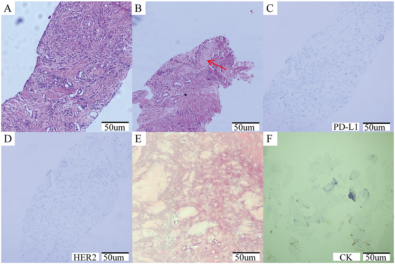 Histological slides A to F showing tissue samples with various staining techniques at 50 micrometers scale. Slide A and B show detailed tissue structure, with B including a red arrow. Slide C is labeled PD-L1, D with HER2, and F with CK, each showing different staining patterns. Slide E shows a lighter, less distinct structure.