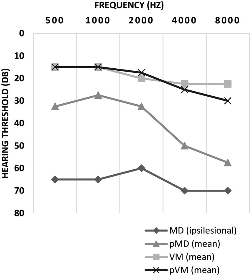 Line graph showing hearing threshold in decibels versus frequency in hertz from 500 to 8000. Four lines represent different categories: MD (ipsilesional), pMD (mean), VM (mean), and pVM (mean). MD remains stable around 60-70 dB, pMD declines from 40 to 60 dB, VM stays at 20 dB, and pVM starts at 20 dB and slightly decreases across frequencies.