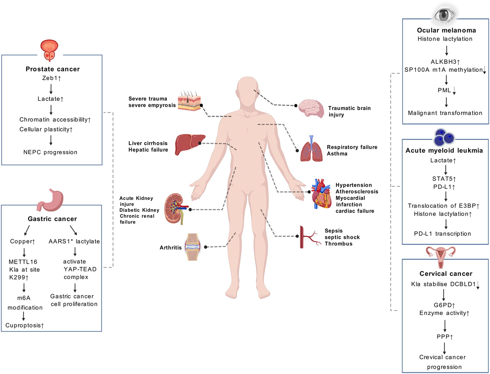 Diagram illustrating various health conditions and their related pathways. Conditions include prostate cancer, gastric cancer, ocular melanoma, acute myeloid leukemia, and cervical cancer. Each condition is linked to different organs in a human body silhouette. Arrows indicate specific biochemical pathways and changes like lactate increase, chromatin accessibility, and histone lactylation contributing to disease progression.