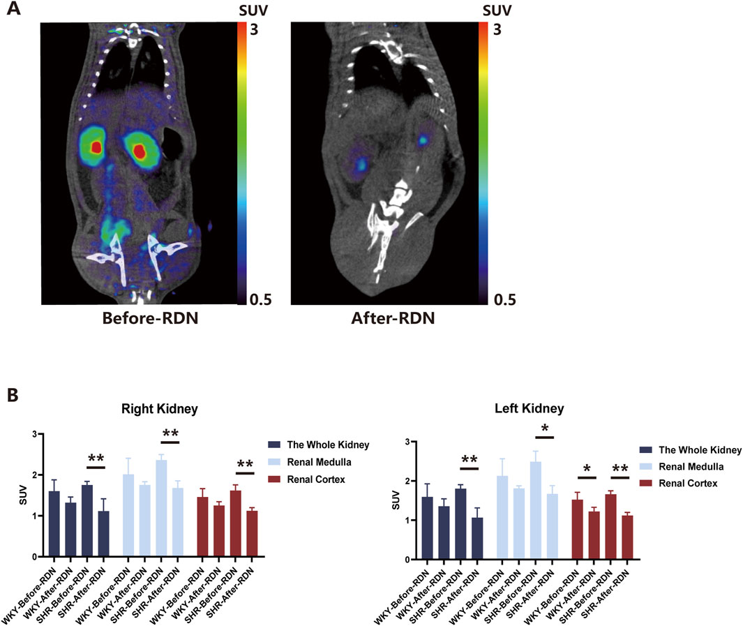 Panel A shows PET-CT scans of a subject before and after renal denervation (RDN), with significant reduction in the standardized uptake value (SUV) post-RDN. Panel B presents bar graphs for the right and left kidneys, comparing SUV of the whole kidney, renal medulla, and renal cortex before and after RDN. Significant differences are marked by asterisks.