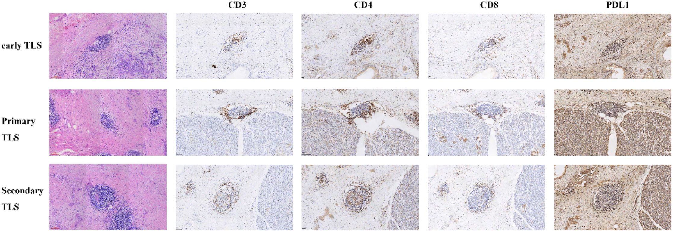 Histological comparison of early, primary, and secondary TLS stages showing staining for CD3, CD4, CD8, and PDL1 markers. Each row represents a TLS stage, with varying intensities and patterns of staining for each marker.