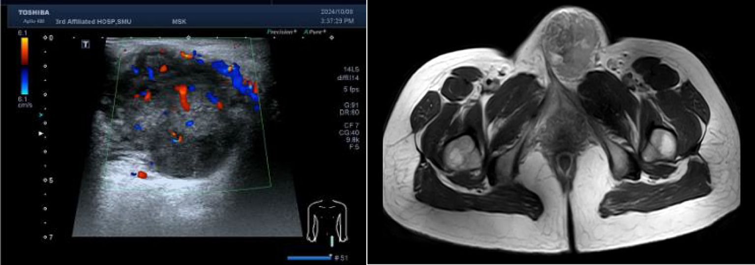 Left side shows a medical ultrasound image with color Doppler highlights in red and blue, indicating blood flow within a soft tissue structure. Right side displays a black and white MRI scan, likely cross-section of the pelvis, highlighting muscle and bone structures.