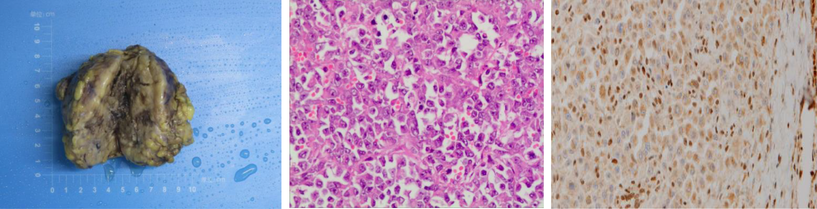 Three-panel image showing a specimen and histological slides. The first panel displays a yellow-brown lobulated mass on a blue background, resembling a pathological specimen. The second panel shows a microscopic view of densely packed purple-stained cells, indicating a tissue slide stained with hematoxylin and eosin. The third panel features another tissue slide with brown-stained cells, likely showing immunohistochemical staining results.
