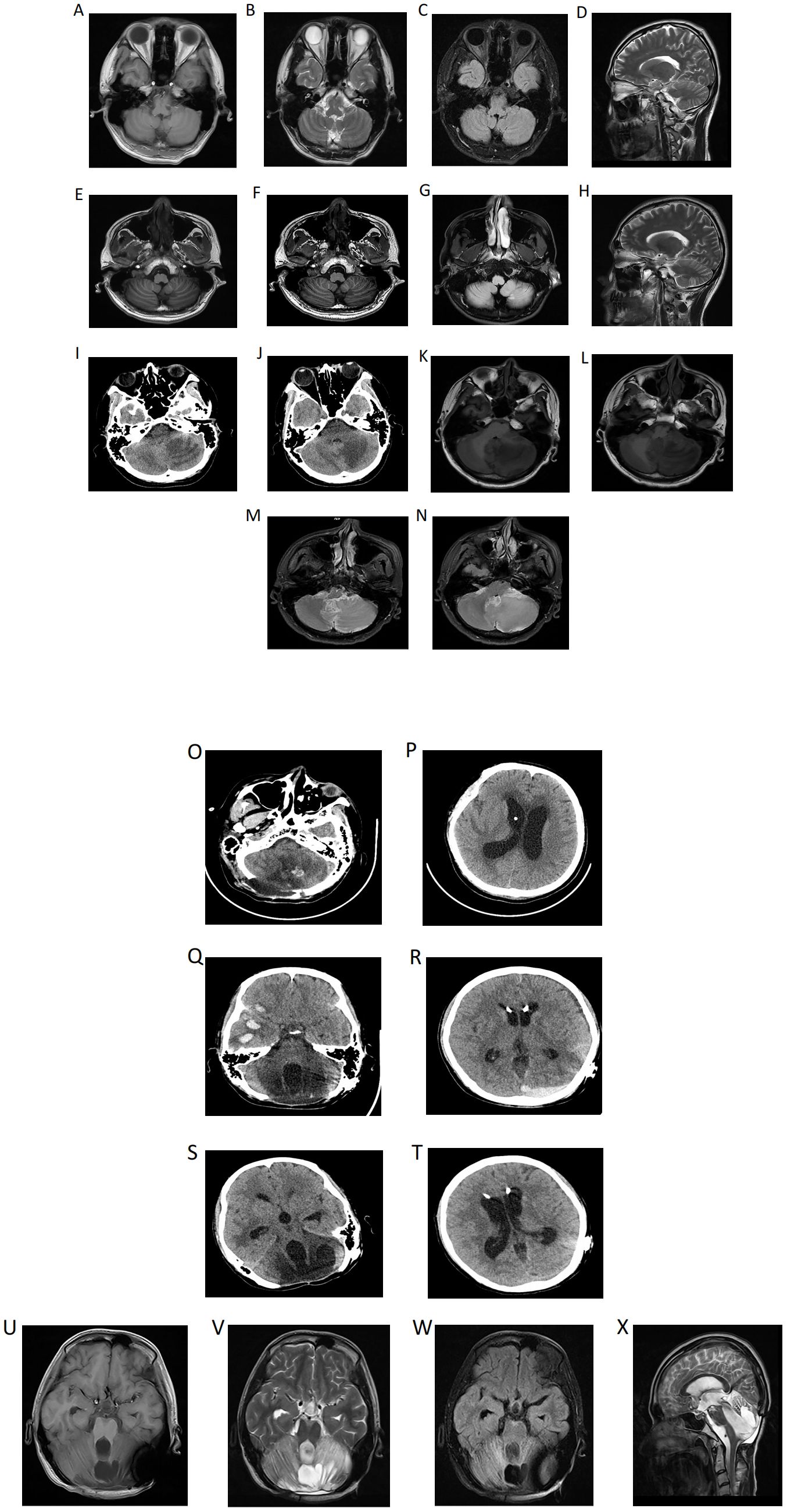 Composite image showing multiple black and white cranial MRI and CT scans from different angles and positions, labeled A to X. The images display various cross-sections and structures of the brain, with differences in contrast and detail highlighting various anatomical features.