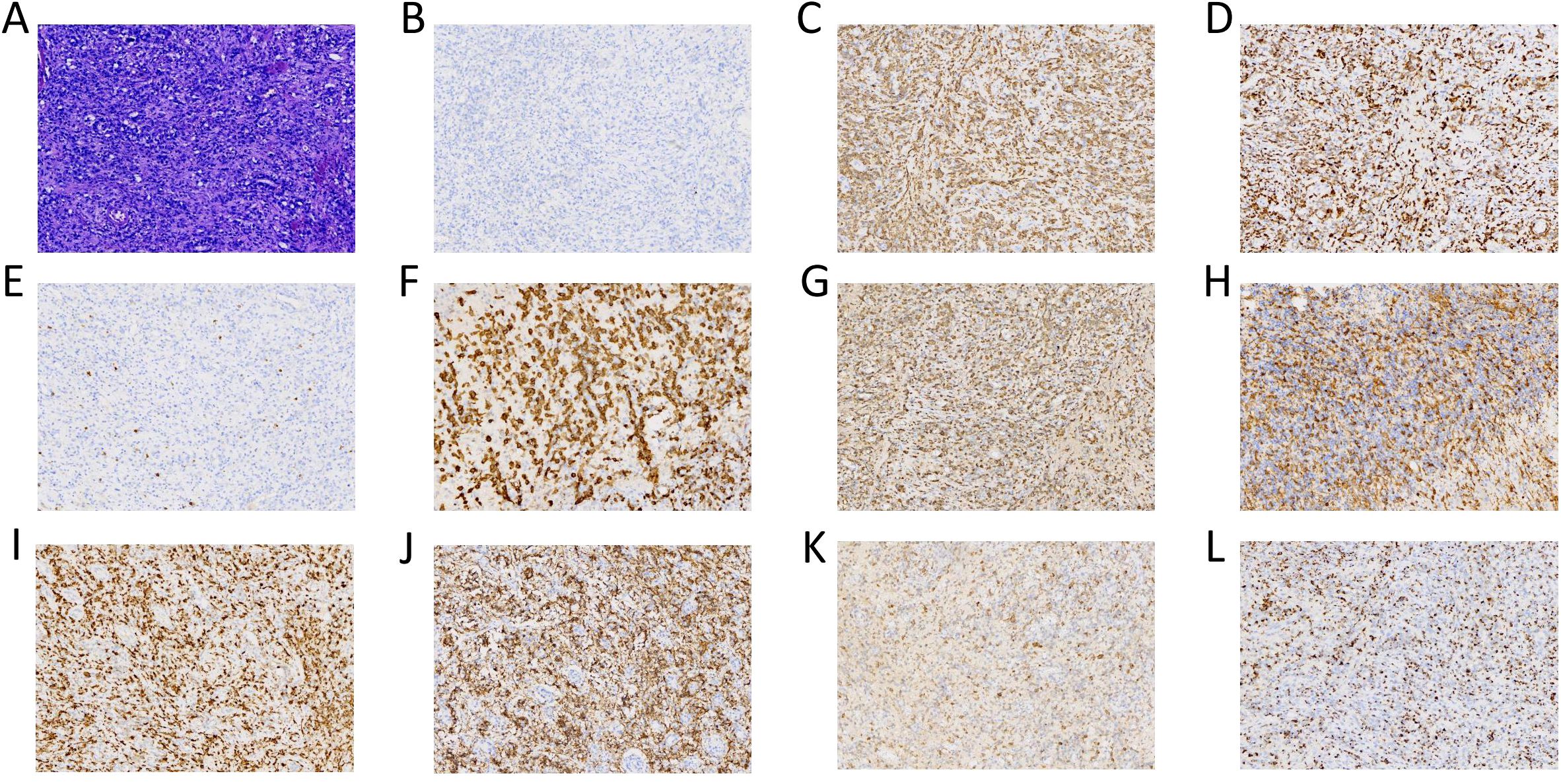 A set of twelve histological slide images labeled A to L, each showcasing different staining patterns and cellular structures. Image A features a dense purple-stained tissue. The remaining images (B to L) depict varying degrees of staining intensity with brown and light colors, indicating differences in protein expression or cellular components. Each image depicts unique textures and patterns, providing comparative insights into tissue characteristics.